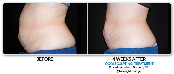 Both men and women can benefit from Coolsculpting. 